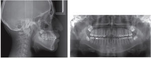 Final radiographs: panoramic and lateral headfilm.