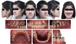 Initial facial and intraoral photographs.