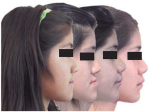 Profile photograph sequence of the patient.