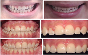 Resins in upper lateral incisors.