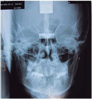 Posteroanterior radiograph. Symmetry is observed with scissor bite on the right side.