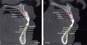 Imagen tomográfica comparativa del aumento del volumen óseo.