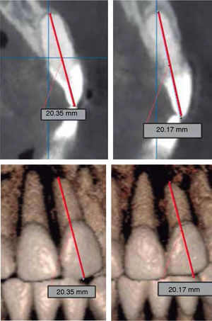 Imágenes tomográficas comparativas de la longitud radicular.
