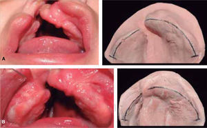 A. Masculino de seis meses de edad, con dx labio y paladar fisurado unilateral derecho completo. Fotografía inicial de agosto 2013 y B. Dos meses después del uso de la placa obturadora estimuladora en octubre 2013.