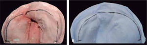 A. Masculino de cinco meses de edad, con dx labio y paladar fisurado unilateral derecho completo. Fotografía inicial de agosto 2013 y B. Dos meses después del uso de la placa obturadora estimuladora en octubre 2013.
