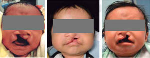 Pacientes con fisura labiopalatina unilateral.