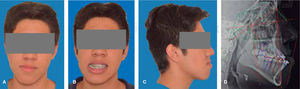Fotos extraorales prequirúrgicas. A. Frontal. B. Sonrisa. C. Perfil derecho. D. Rx lateral de cráneo prequirúrgica.