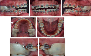 Progreso: miniimplantes en el paladar entre primer y segundo molar y bite block modificado activado con cadenas elásticas.