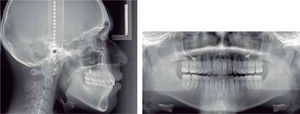 Lateral de cráneo final y ortopantomografía.
