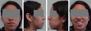 Aspecto facial pre-tratamiento: A. Frontal, B. Perfil derecho, C. Perfil izquierdo y D. Sonrisa.