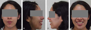 Aspecto facial postratamiento: A. Frontal, B. Perfil derecho, C. Perfil izquierdo, D. Sonrisa.