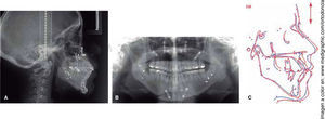 A. Radiografía lateral de cráneo postquirúrgica, B. Radiografía panorámica postquirúrgica, C. Sobreimposición cefalométrica (azul: prequirúrgica, rojo: postquirúrgica).