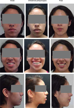 Cambios faciales frente, sonrisa y perfil del paciente.