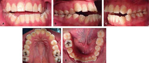 Fotografías dentales pretratamiento: A. Frontal, B. Lateral derecha, C. Lateral izquierda, D. Oclusal superior y E. Oclusal inferior.