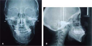 A. Radiografía posteroanterior pre-quirúrgica, y B. Radiografía lateral de cráneo pre-quirúrgica.