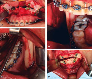 A. Osteotomía LeFort 1, B. y C. Osteotomía sagital de la rama bilateral, y D. Mentoplastia.