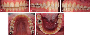 Fotografías dentales postratamiento: A. Frontal, B. Lateral derecha, C. Lateral izquierda, D. Oclusal superior, y E. Oclusal inferior.