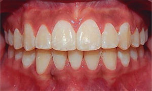 Final intraoral front photograph.