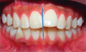 Intraoral frontal photograph.