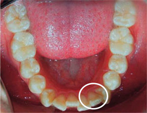 Initial lower occlusal photograph.