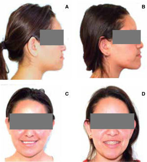 A Profile photograph before the surgical expansion treatment where the upper lip collapse may be observed. B. Profile photograph after the expansion where the modification of the nasolabial angle is more noticeable due to the protrusion of the upper lip. C. Frontal photograph before treatment. The patient looks older due to the maxillary collapse and due to the poor upper incisor exposure. D. Frontal photograph after the expansion. The patient's face looks more her age, the inciso r exposure increased thus favoring the smile height.