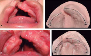 A. Male patient, six months of age with complete unilateral right cleft lip and palate. Initial photographs from August 2013 and B. Two months after the use of the stimulating obturator in October 2013.