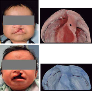 A. Male patient, two months old with complete unilateral right cleft lip and palate. Initial photographs from November 2013 and B. Two months after the use of the stimulating obturator in January 2013.