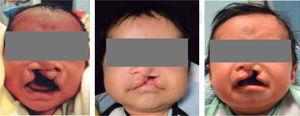 Patients with unilateral cleft lip and palate.