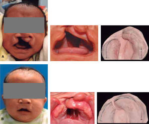 A. Male patient, six months of age with complete unilateral right cleft lip and palate. Initial photograph on August 2013 and B. Two months after the use of the stimulating obturator.