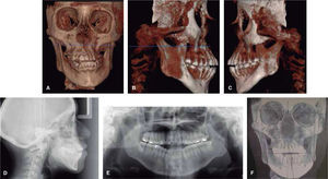 A. CBCT frontal view, B. CBCT right lateral view, C. CBCT left lateral view, D. Lateral head film, E. Panoramic radiograph, F. CBCT posterior view.
