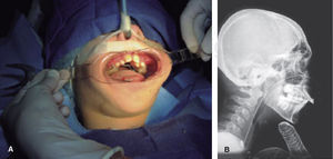 PCNE en TO bajo anestesia general. A. Colocación de expansor. B. Radiografía lateral de cráneo. Fuente: Rada et al.10.