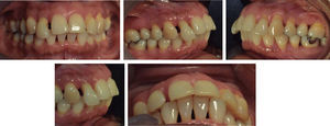 Imágenes intraorales antes del tratamiento de ortodoncia.
