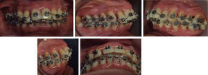 Imágenes intraorales durante el tratamiento de ortodoncia.
