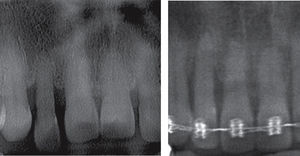 Imagen radiográfica antes y durante el tratamiento de intrusión ortodóncica.