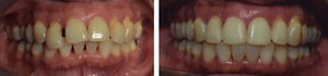 Imagen intraoral antes y después de intrusión ortodóncica.