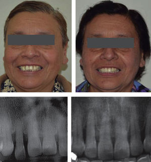 Imagen extraoral y radiográfica antes y después de intrusión ortodóncica.