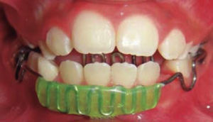 Trampa lingual y lip-bumper.