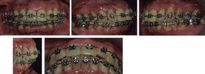 Intraoral photographs after orthodontic intrusion.