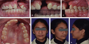 A. Front view. B. 9mm fissure. C, D. Intraoral left photograph, occlusal. View E, F, G. Initial facial photographs.