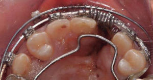 Auxiliary labial arch as a guide for the closed coil anchored to the modified plates.