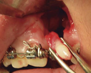Surgical removal of the supernumerary.