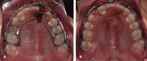 A. Initial occlusal view. B. Final occlusal view.