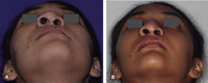 A y B. Submental comparative, note the improvement in the left side of the nose and lips.