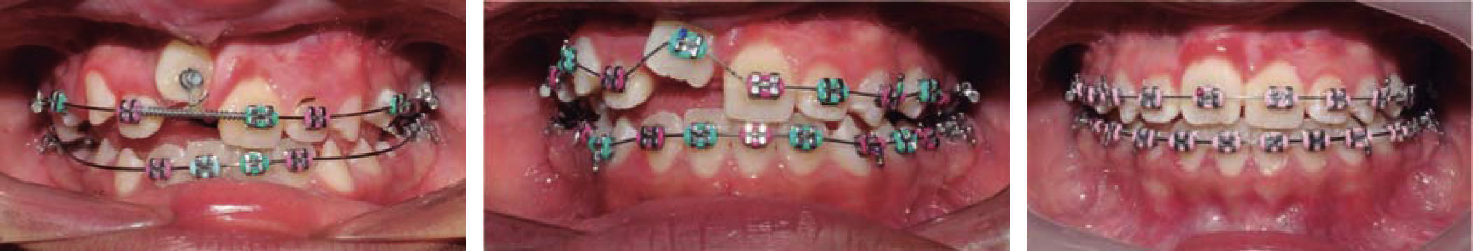 Orthodontic-surgical treatment of an impacted central incisor. Case ...