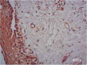 Inmunoexpresión positiva de TGF-β3 en células epiteliales de un paciente con paladar hendido completo (400x).