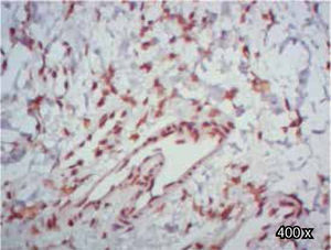Inmunoexpresión positiva de TGFβ-RIII, en fibroblastos de un paciente con paladar hendido completo (400x).