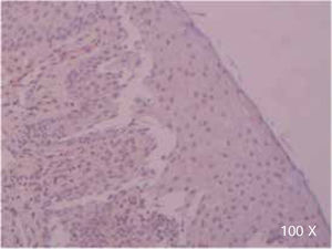 Inmunoexpresión ausente de TGFβ-RIII en células epiteliales de TGFb-RIII en células epiteliales de un paciente con paladar hendido completo (100x).