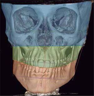 Dinámica de la desviación lateral mandibular característica en la elongación hemimandibular.