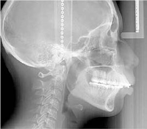 Radiografía lateral de cráneo pre-quirúrgica.