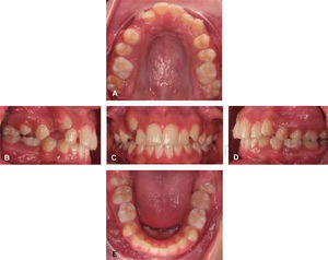 Intraoral photographs. A. Upper arch. B. Right side. C. Frontal. D. Left side. E. Lower arch.